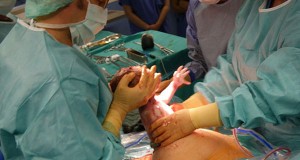 Cesarean Delivery Doubles Risk for Childhood Obesity