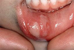 Mouth ulcers: Symptoms, treatment and prevention